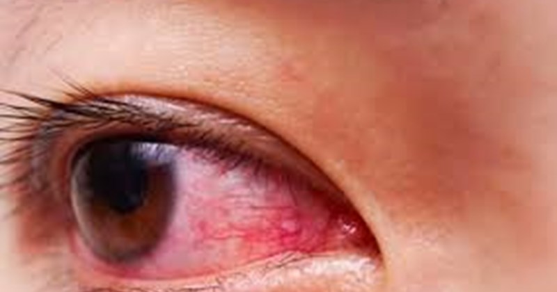 Khuyến cáo phòng bệnh đau mắt đỏ